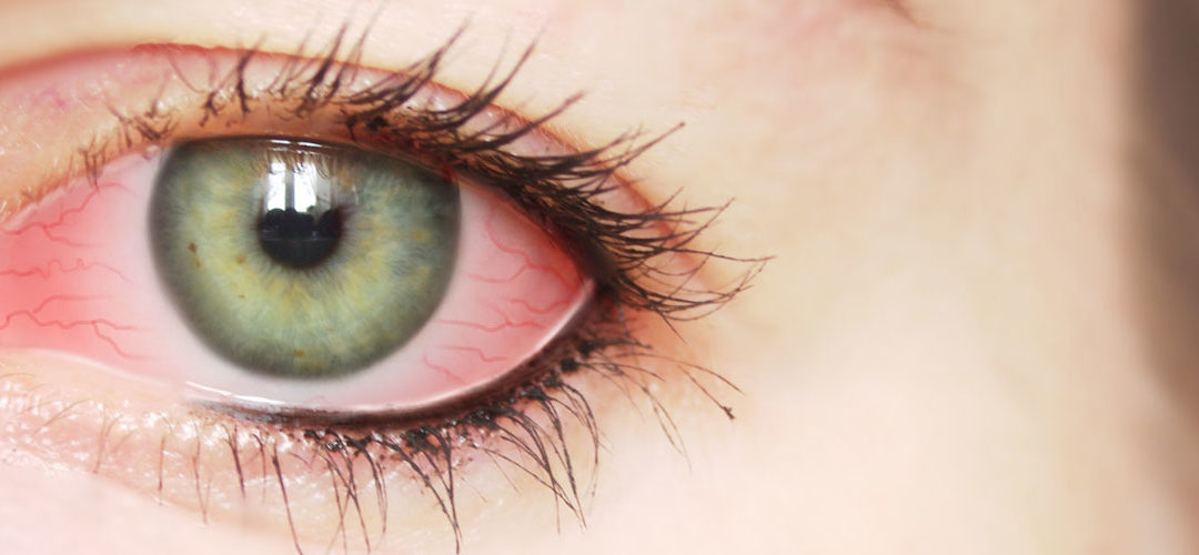 Conjunctivitis (pink eye and allergies)