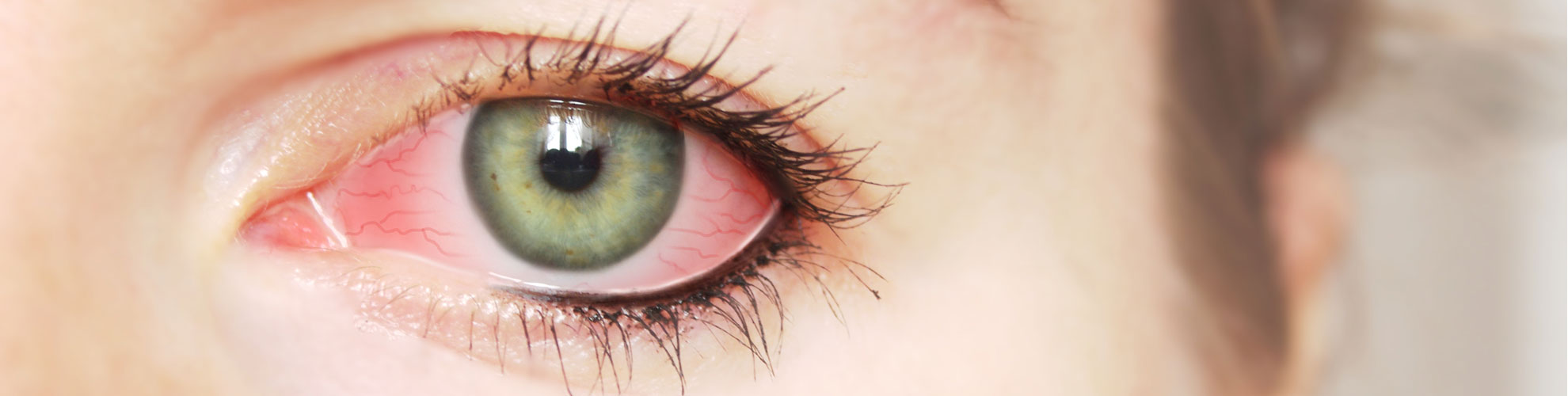 Conjunctivitis (pink eye and allergies) SCOPA